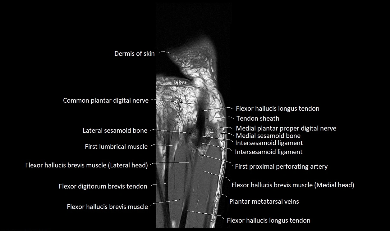 Great Toe micro anatomy MRI axial cross sectional 3T image 22.webp